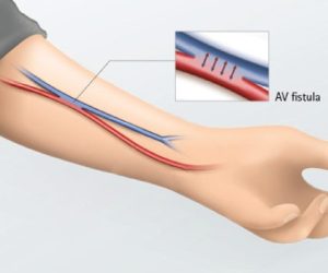 What-is-AV-Fistula